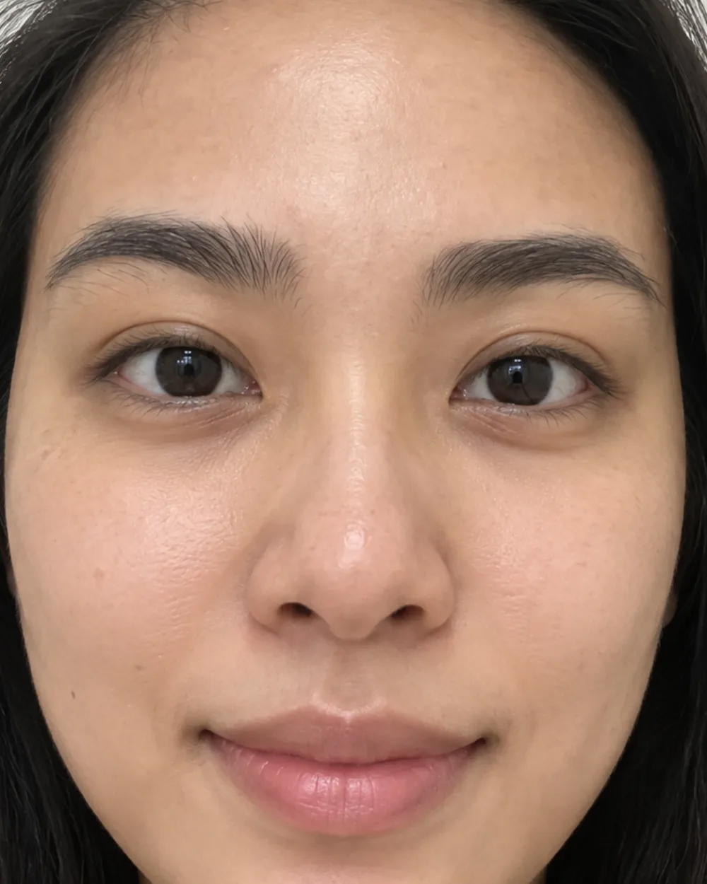 Case one, after: the forehead is smooth, with the raised bumps gone.