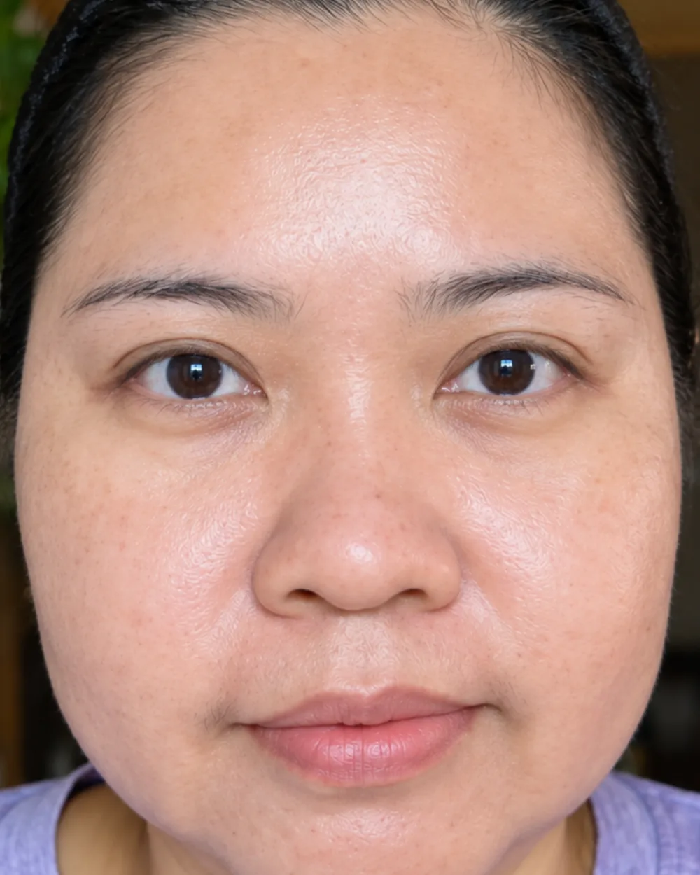 Case three, after: the pigmentation has faded and the raised spots have settled.