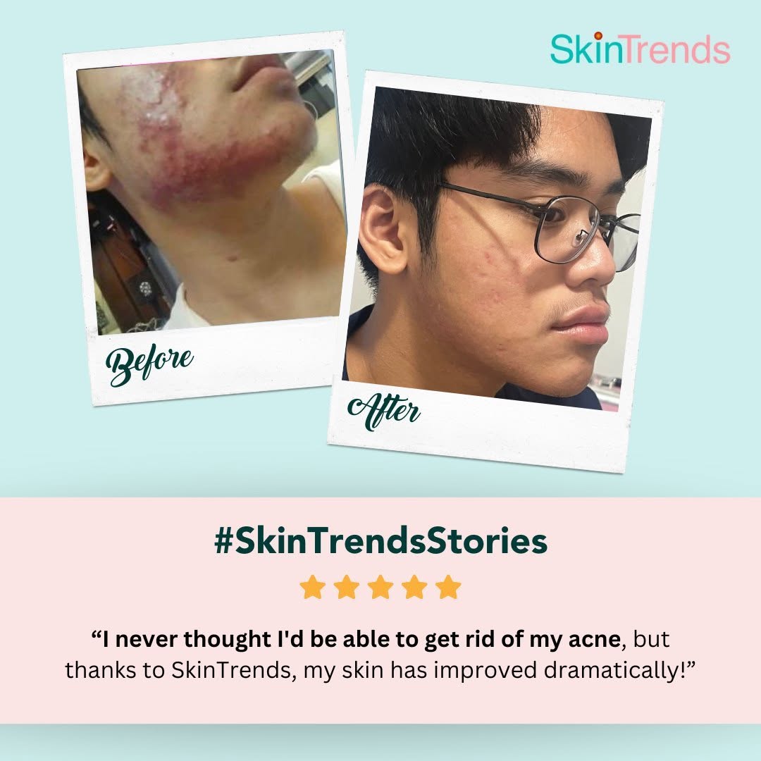 #SkinTrendsStories — Before and after acne treatment. Patient testimonial: I never thought I'd be able to get rid of my acne, but thanks to SkinTrends, my skin has improved dramatically!